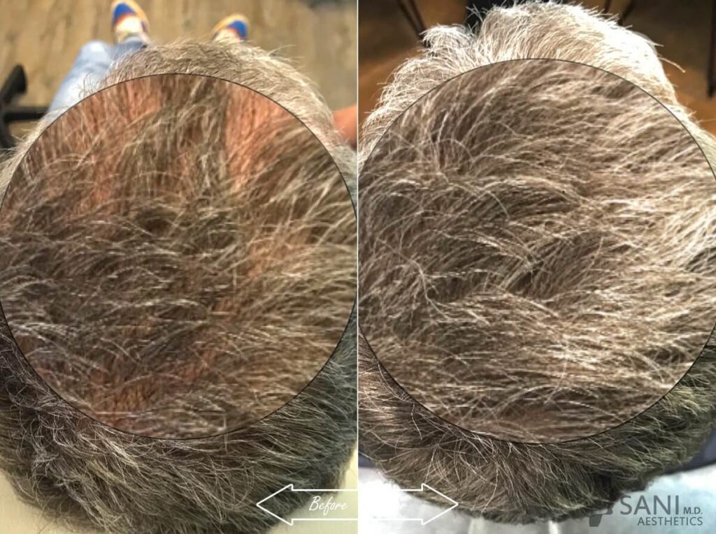 PRP Hair Restoration Before After