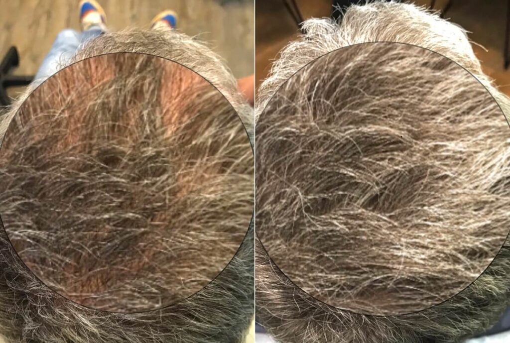 PRP Hair Restoration Before After