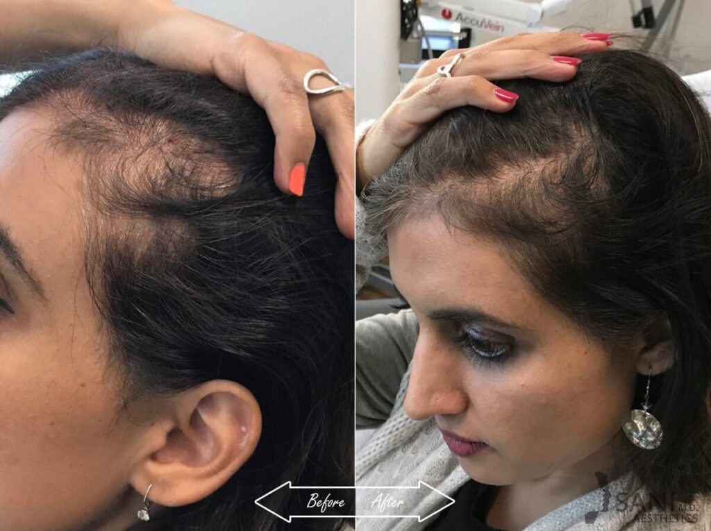 PRP Hair Restoration Before After 20