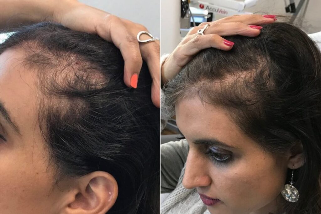 PRP Hair Restoration Before After