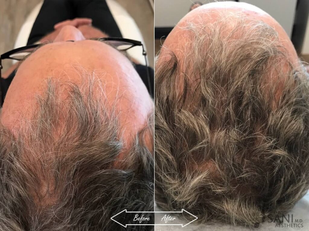 PRP Hair Restoration Before After