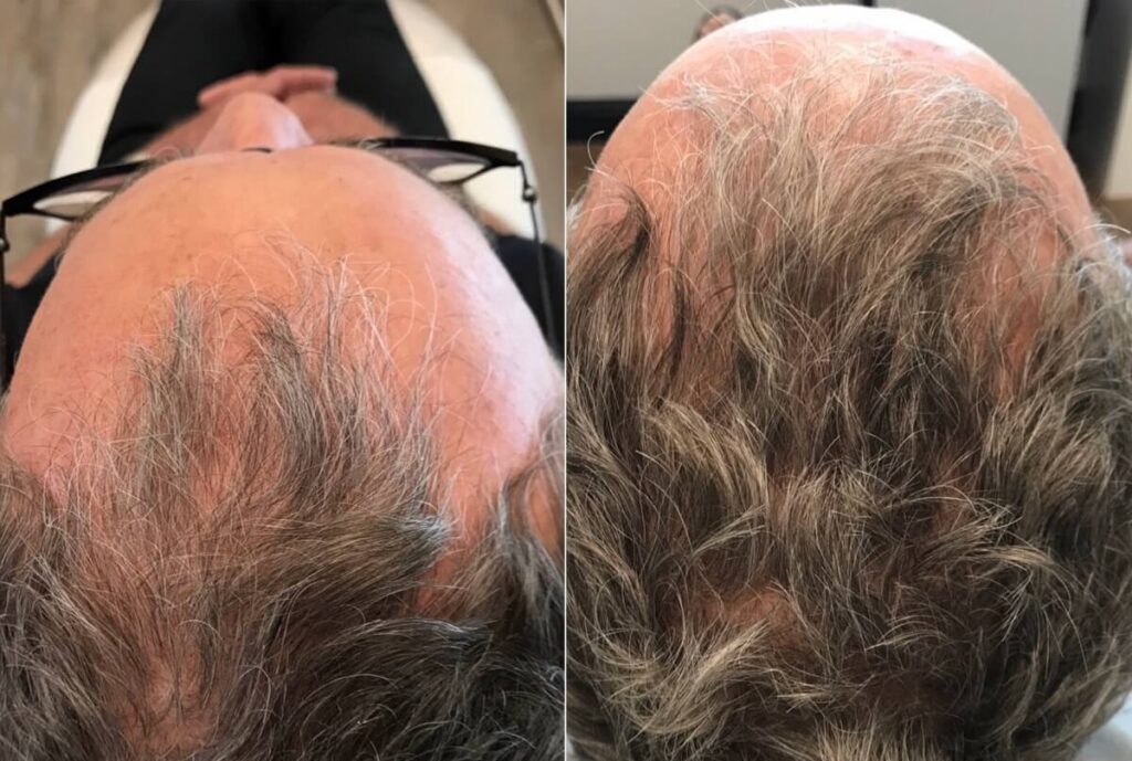 PRP Hair Restoration Before After