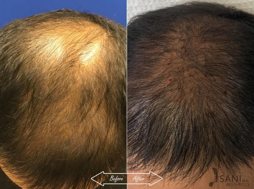 PRP Hair Restoration Before After