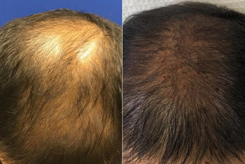 PRP Hair Restoration Before After