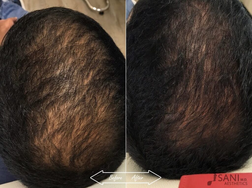 PRP Hair Restoration Before After