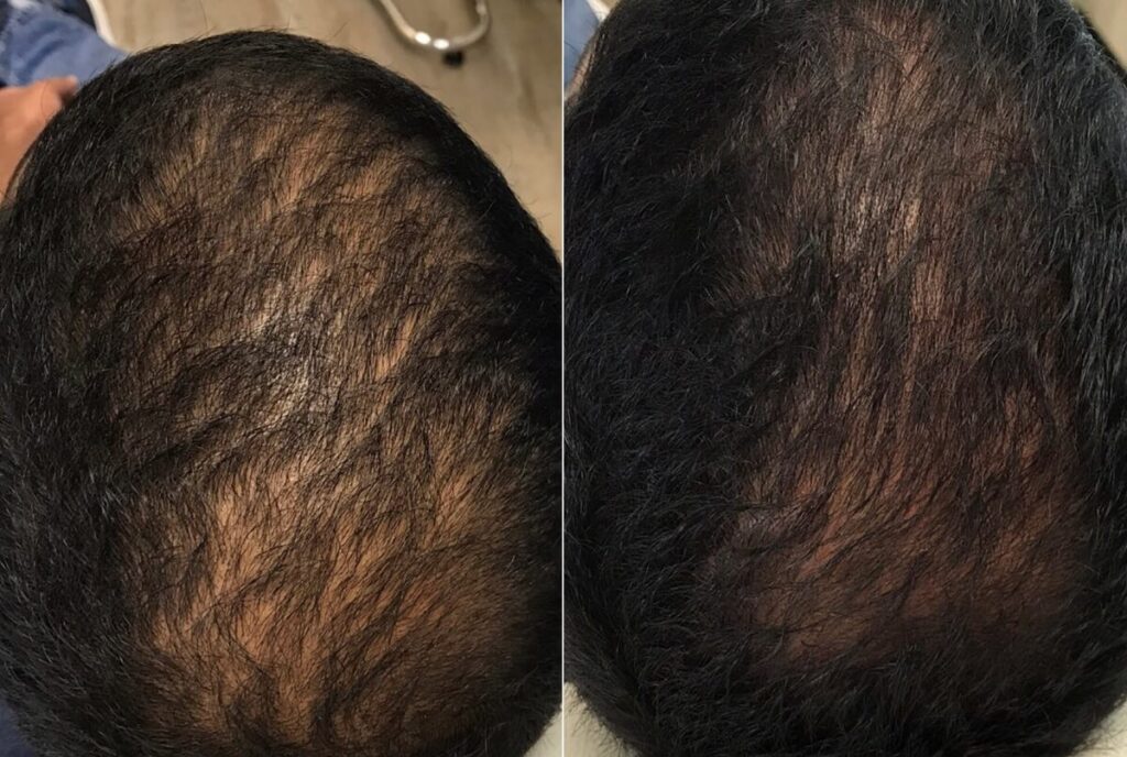 PRP Hair Restoration Before After