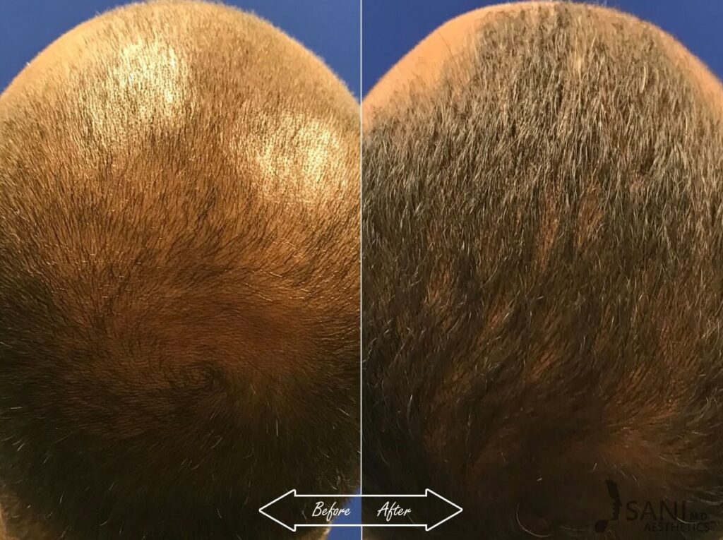 PRP Hair Restoration Before After