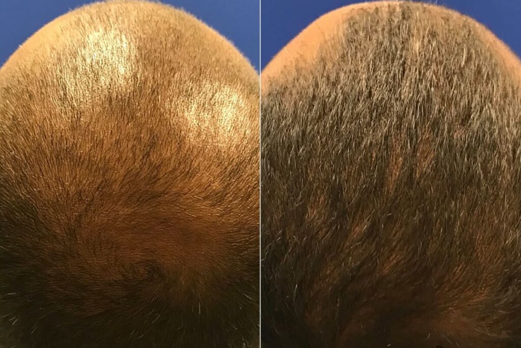PRP Hair Restoration Before After