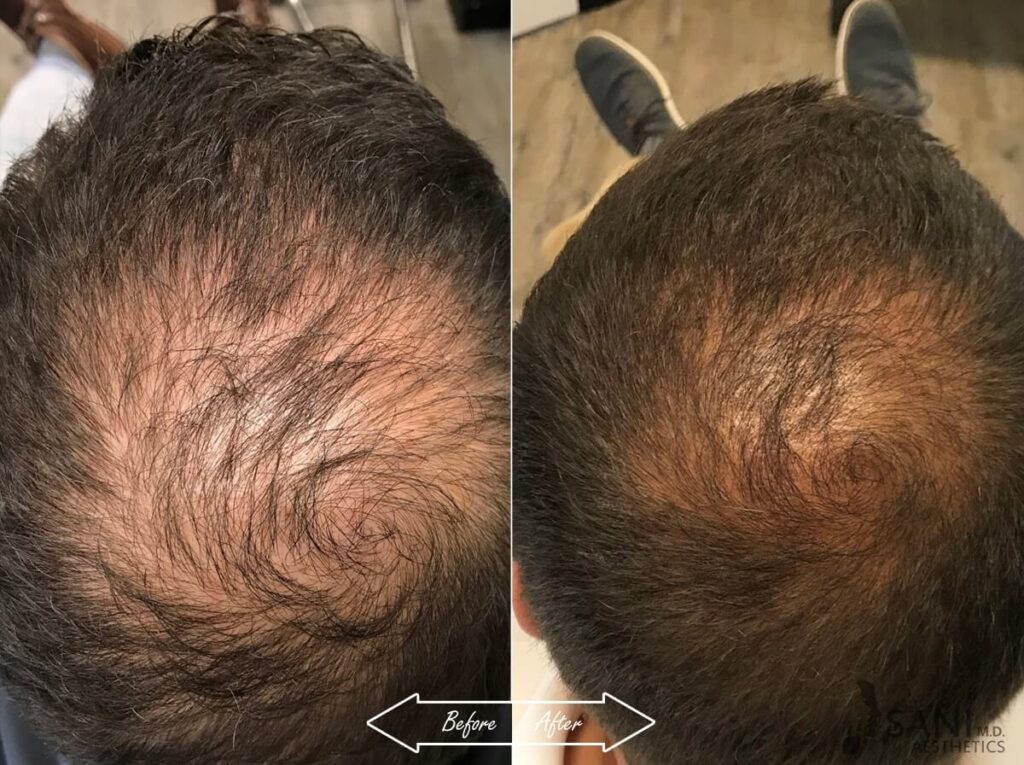 PRP Hair Restoration Before After