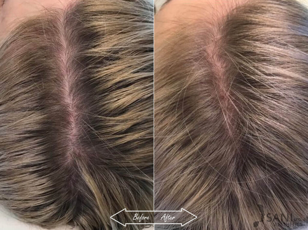 PRP Hair Restoration Before After