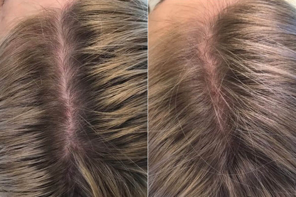 PRP Hair Restoration Before After