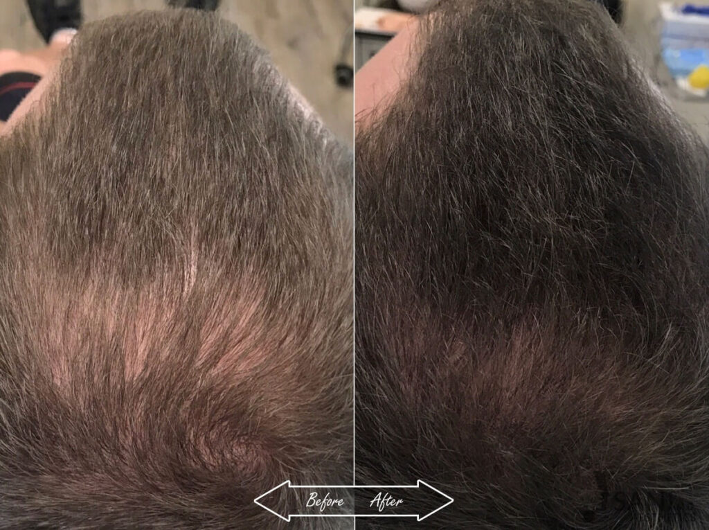 PRP Hair Restoration Before After