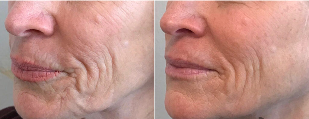 Radiesse Before After 1