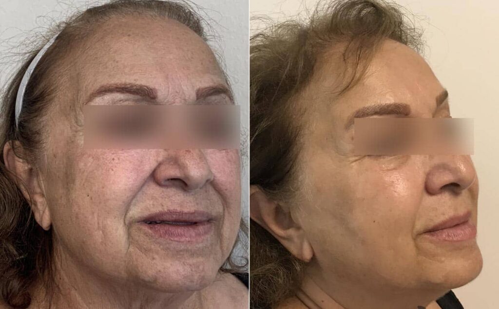 Skinvive Before After First