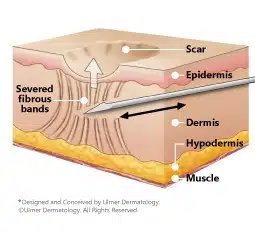 Subcision Acne Scar