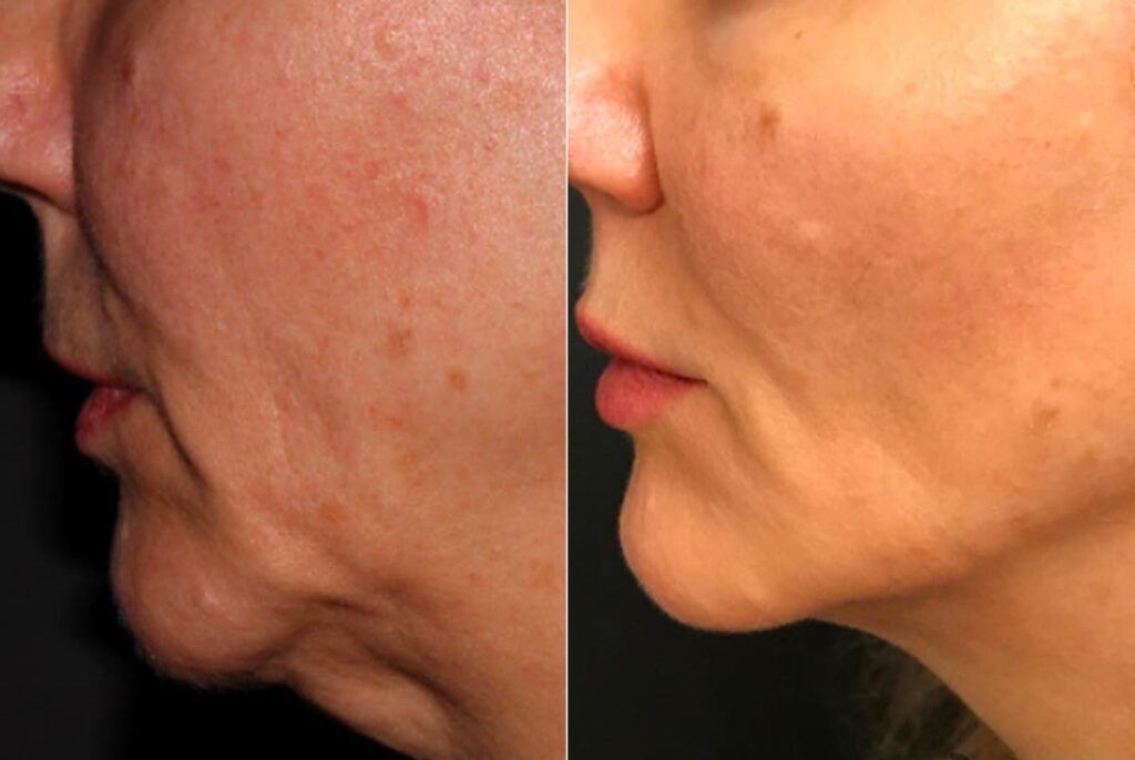 Ultherapy Before After 1