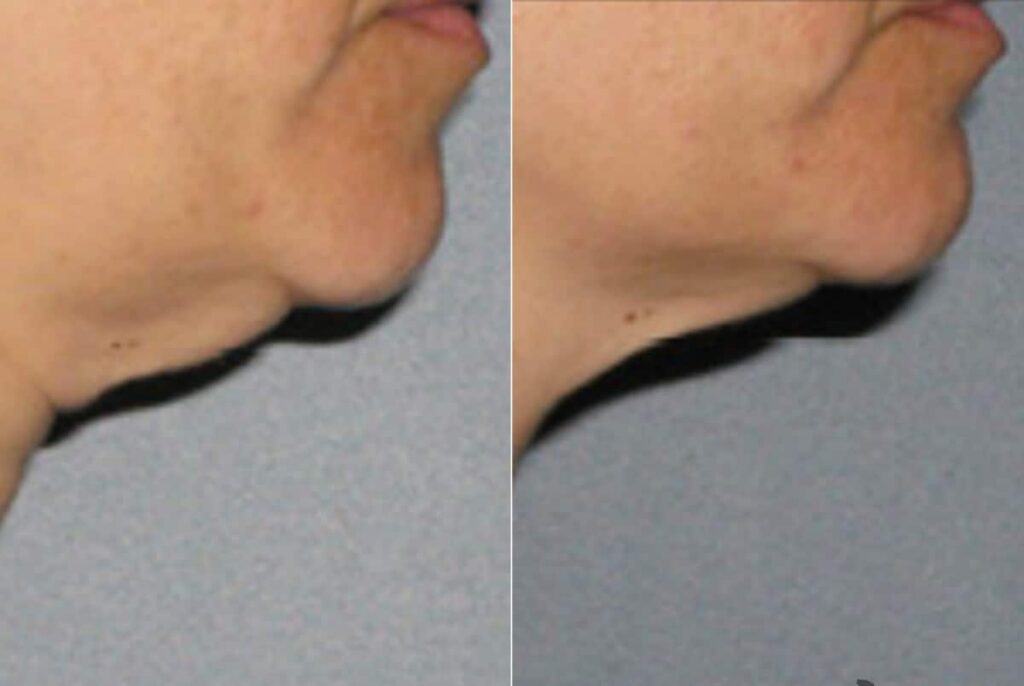 Ultherapy Before After 2