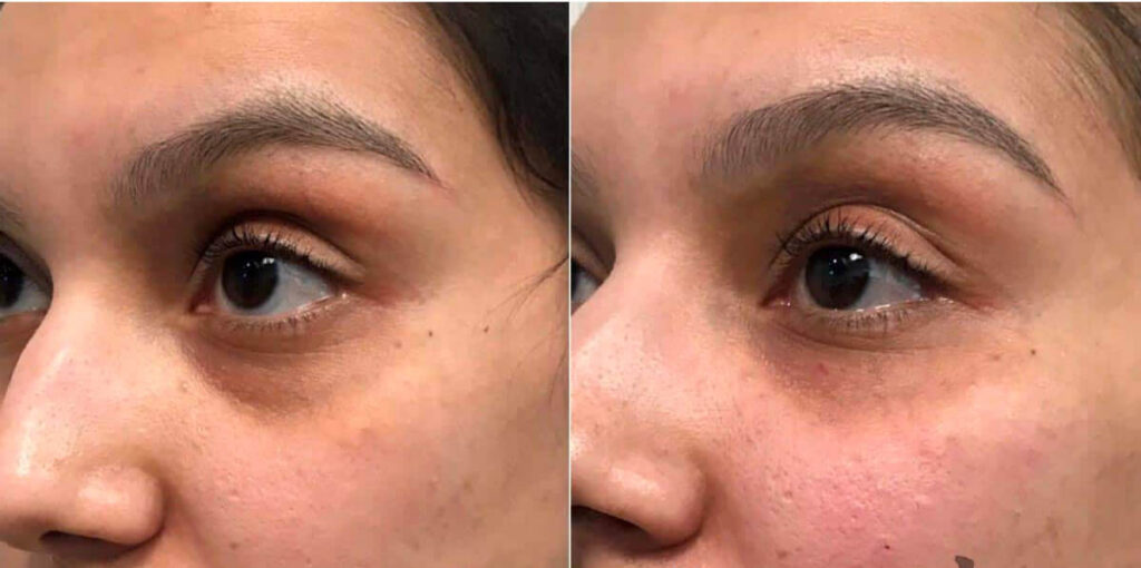 Under Eyes Filler Before After 1