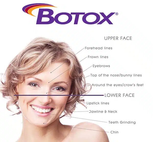 botox upper-lower face