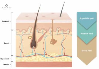 chemical peel penetration depth
