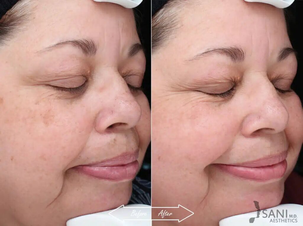 Skin Discoloration, Age-Spots, Sun Spots Treatment Before and After