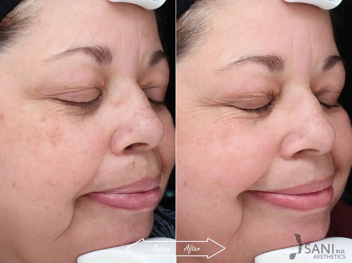 Skin Discoloration, Age-Spots, Sun Spots Treatment Before and After