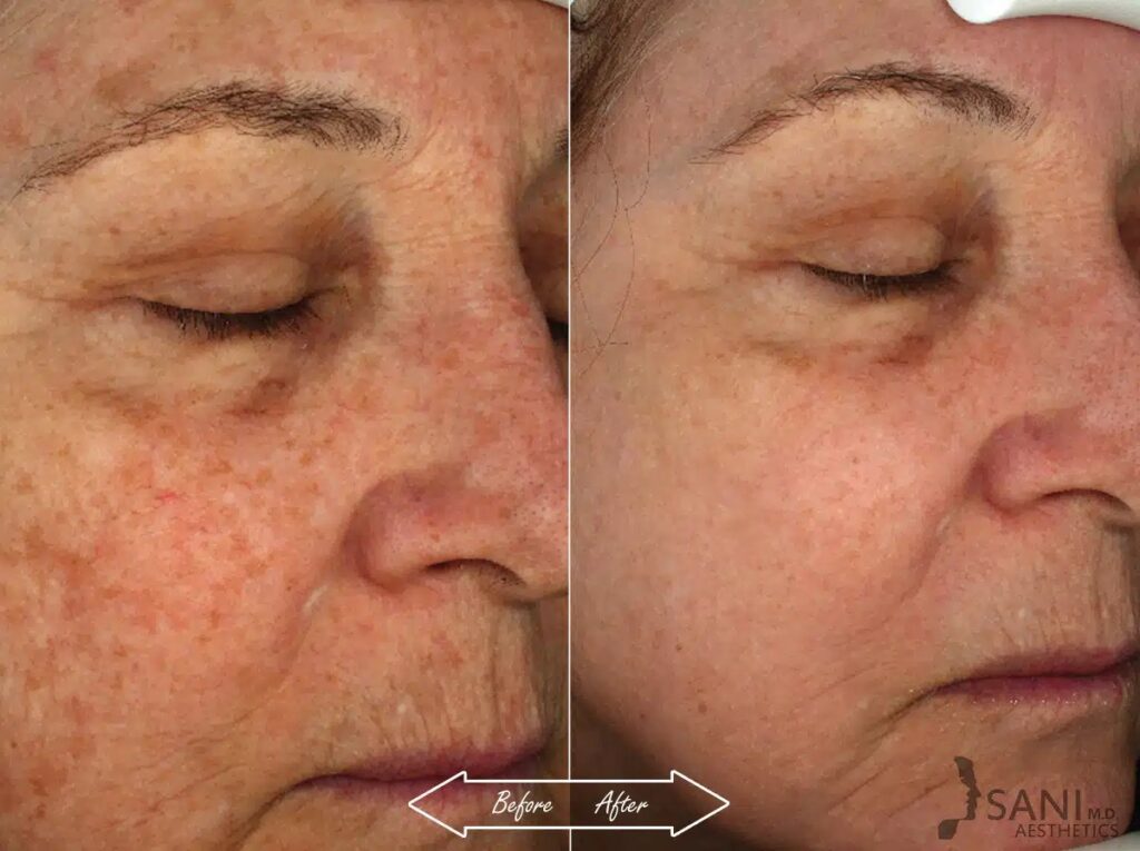 Skin Discoloration, Age-Spots, Sun Spots Treatment Before and After