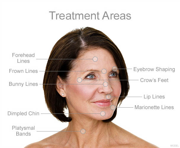 dysport treatment areas