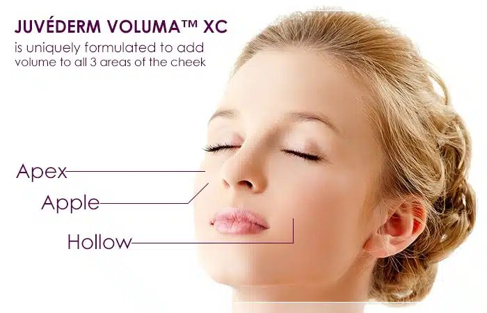 juvederm voluma xc