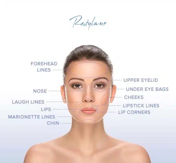 restylane areas