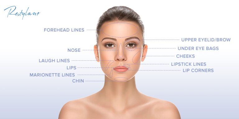 restylane areas