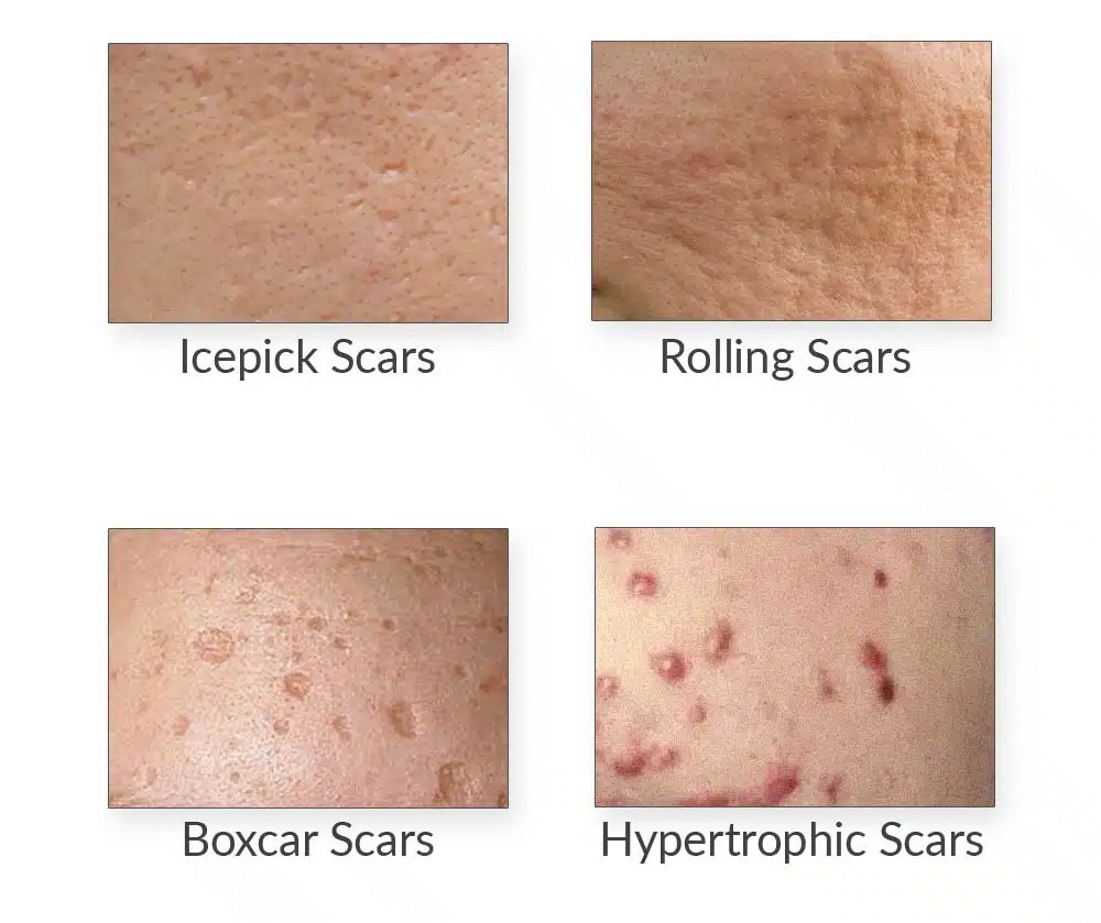 acne scar removal rf
