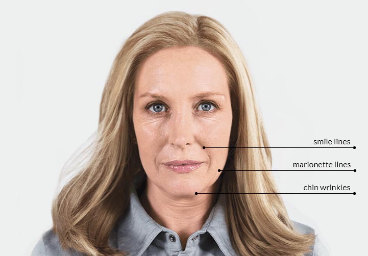 sculptra treatment areas