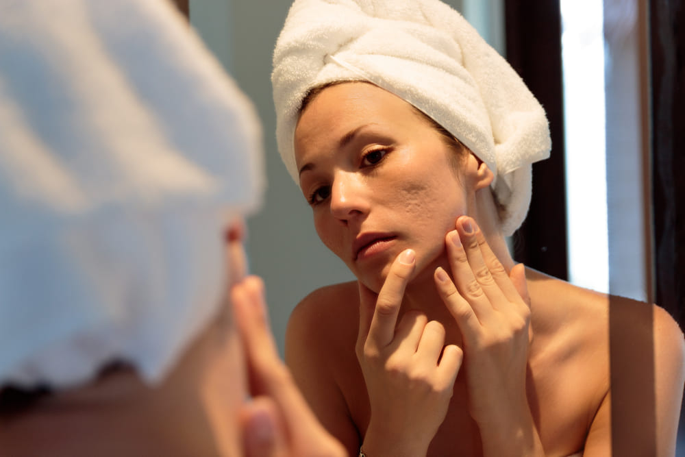 beautiful girl with acne looking herself on the mirror