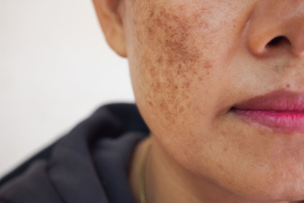 Problem skincare and health concept. Wrinkles, melasma, Dark spots, freckles, dry skin on face middle age woman .