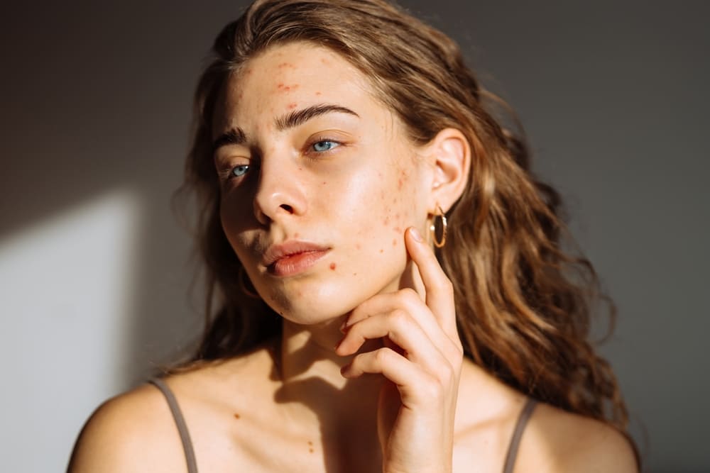 Acne on woman's face with rash skin, scar and spot that allergic to cosmetics.