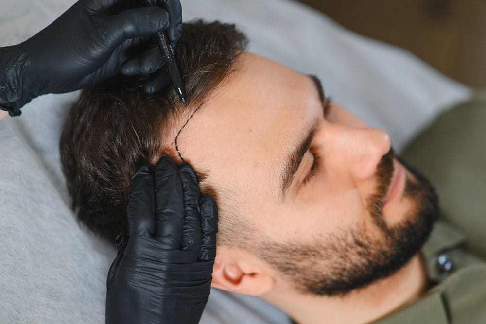 Patient undergoing preparation for hair restoration procedure.