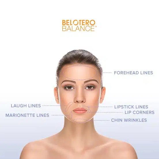 treatment areas belotero