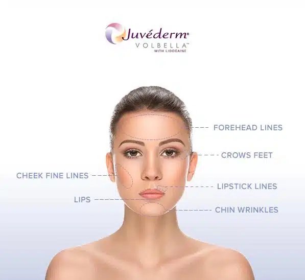 treatment areas volbella