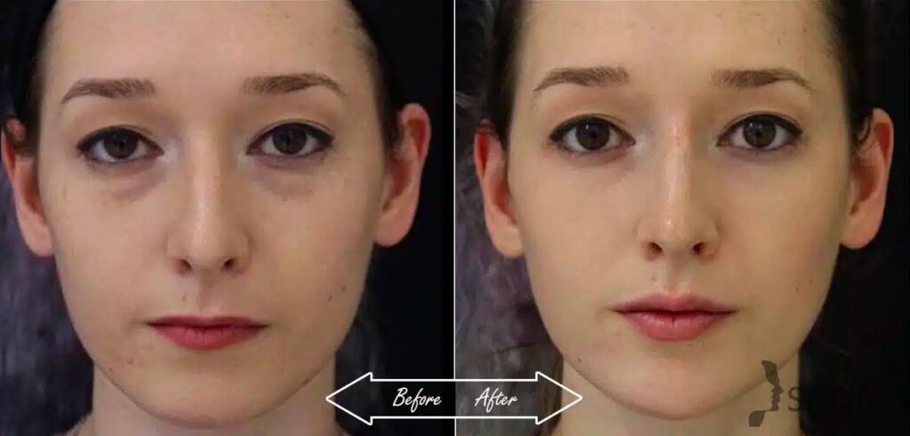 Undereye Dark Circle Treatment Before and After