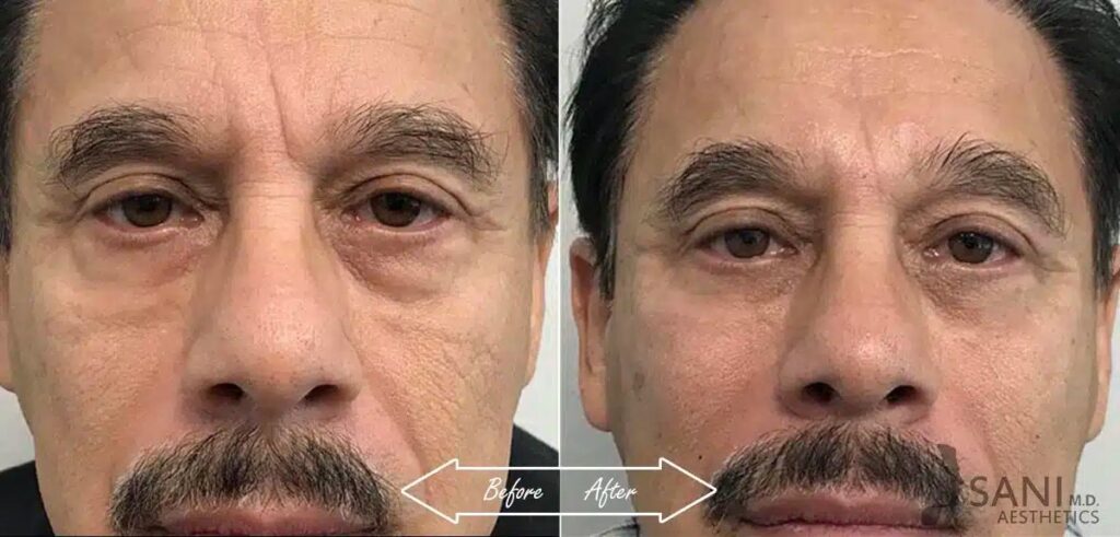 Undereye Dark Circle Treatment Before and After