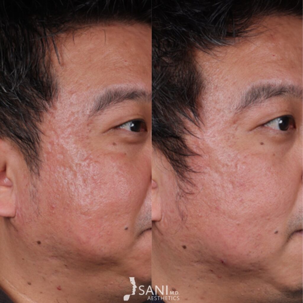 Acne Scar -before and after