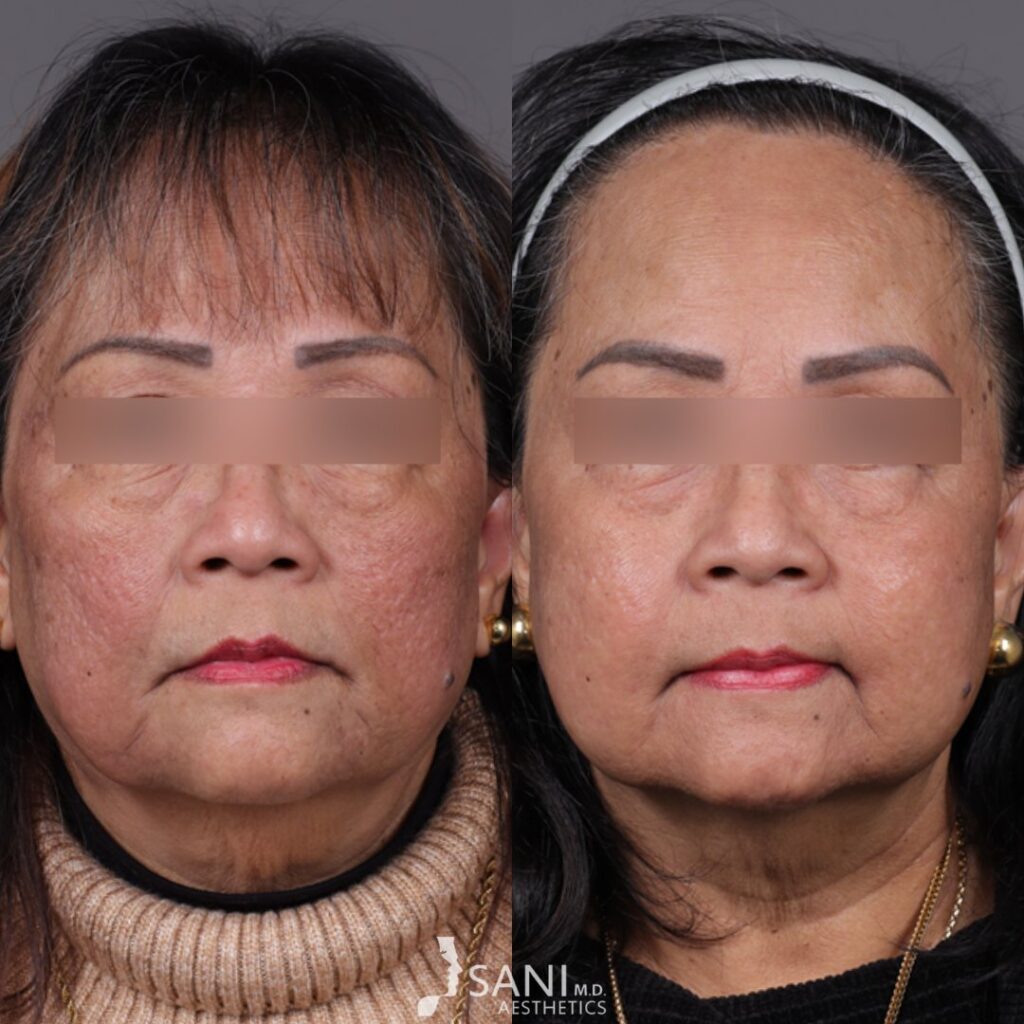 Acne Scar -before and after