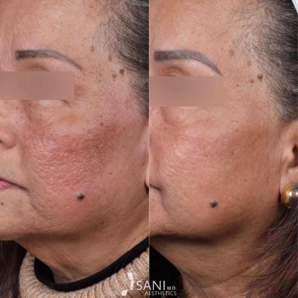 Acne Scar -before and after