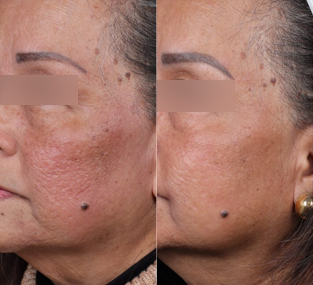 Acne Scar -before and after
