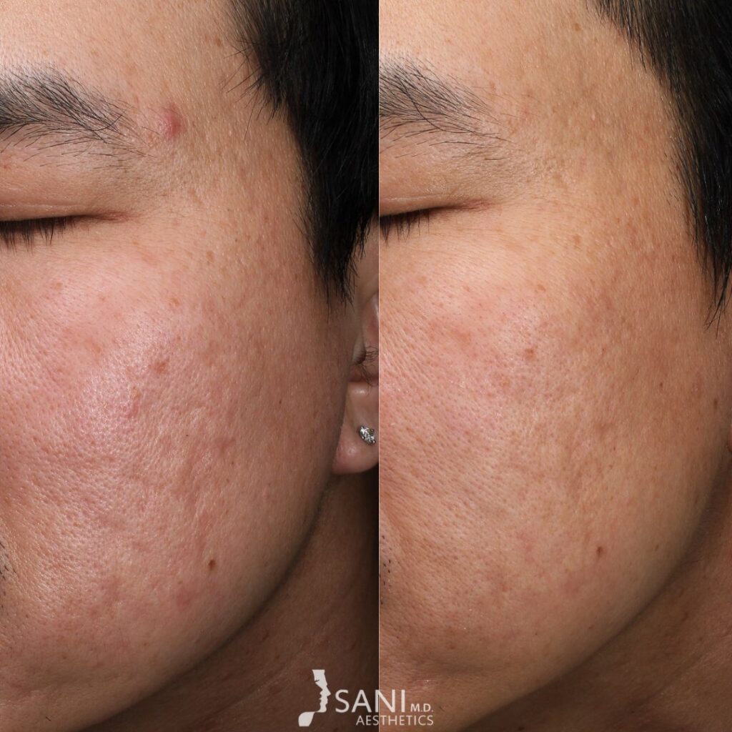 Acne Scar -before and after