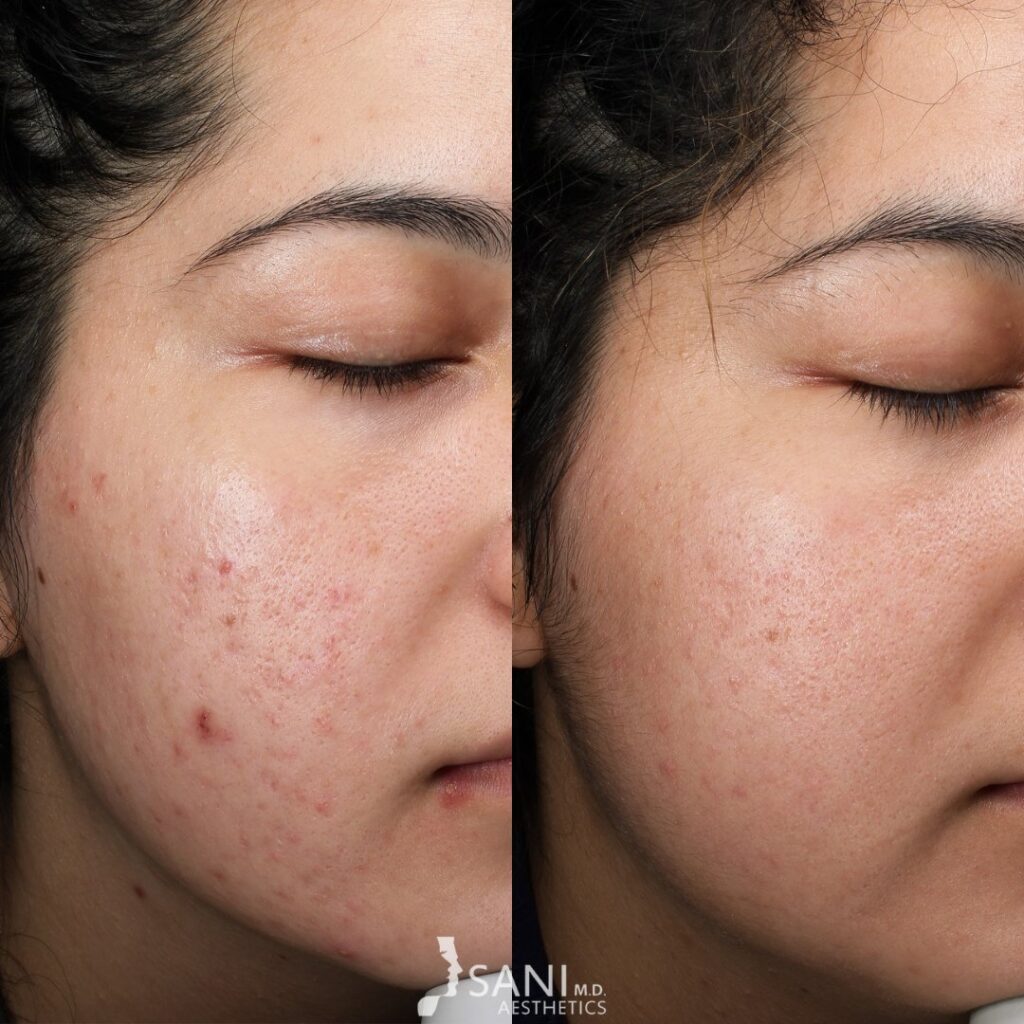 Acne Scar -before and after