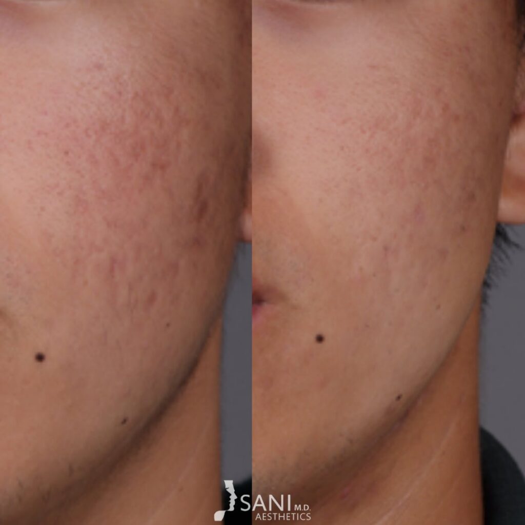 Acne Scar -before and after