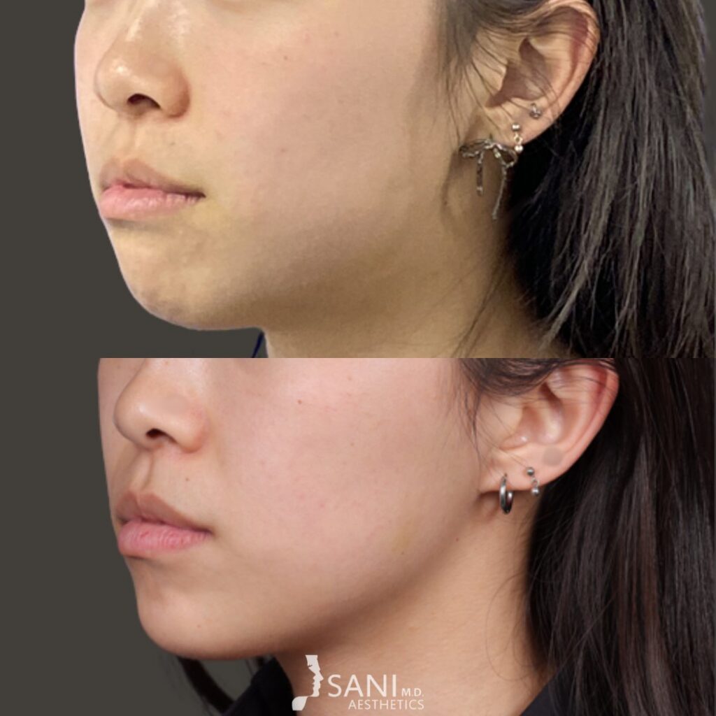 Botox- before and after
