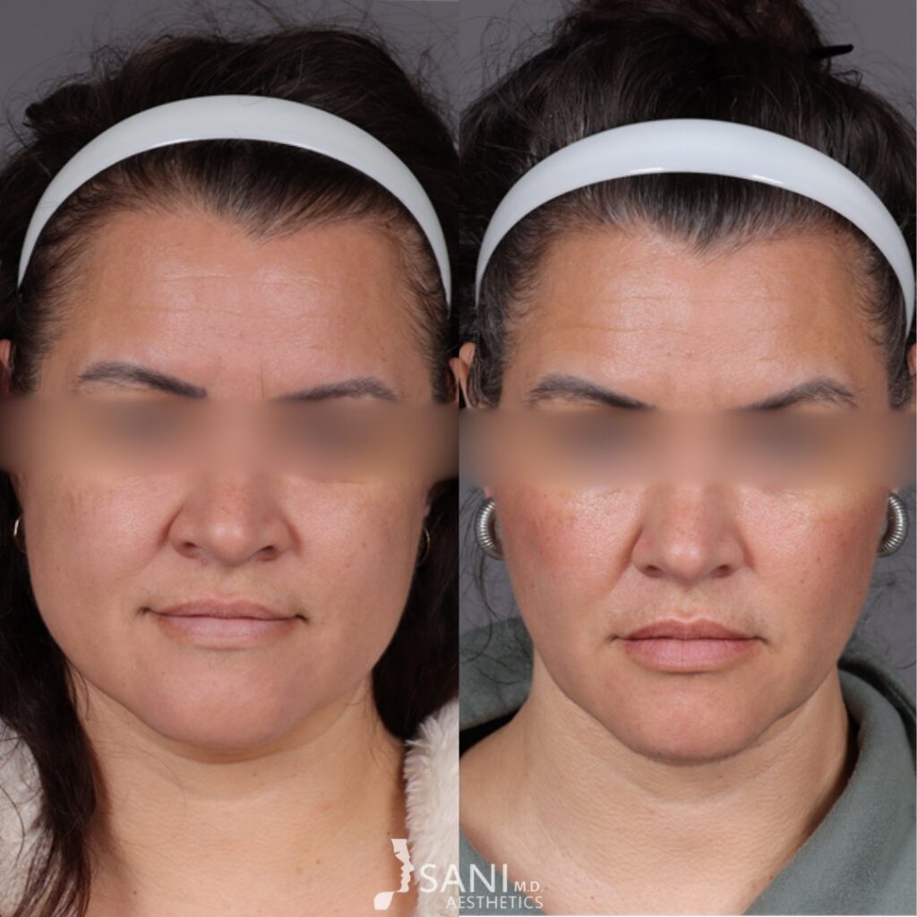 Botox- before and after